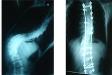 Vẹo cột sống: điều chỉnh được mức cong 170 độ