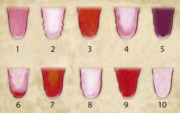 Xem lưỡi đoán bệnh bằng y học cổ truyền - Ảnh 3.